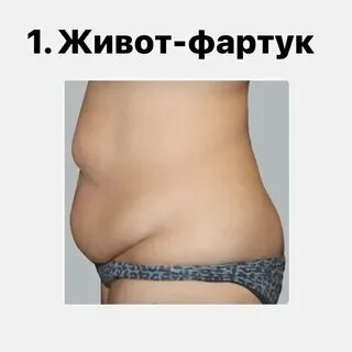 Живот фартук у женщин