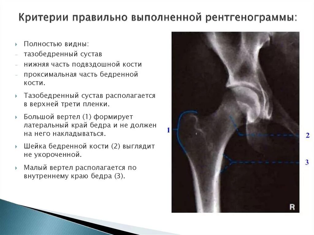 Норма тазобедренных суставов у детей рентгенодиагностика. Рентген анатомия тазобедренных суставов норма. Вывих тазобедренного сустава аксиальная проекция. Описание рентгена тазобедренного сустава. Отек шейки бедра