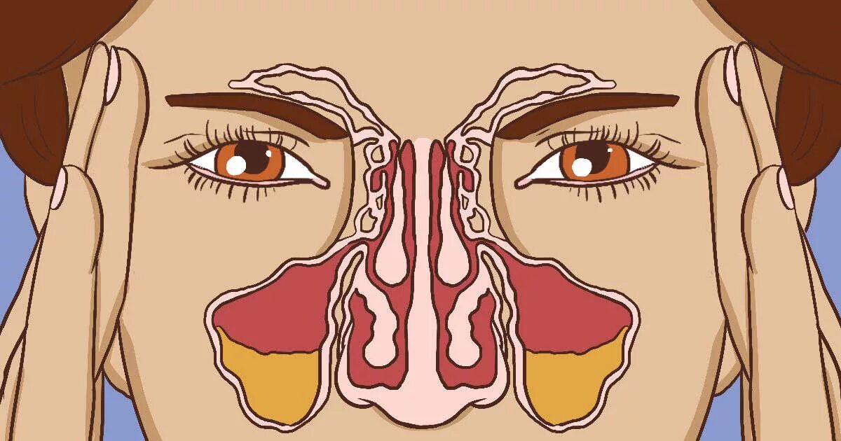 Параназальный синусит. Затруднение носового дыхания. Заложенность выше носа