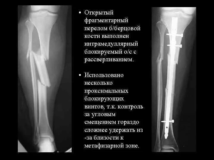 Перелом берцовых. Перелом берцовых