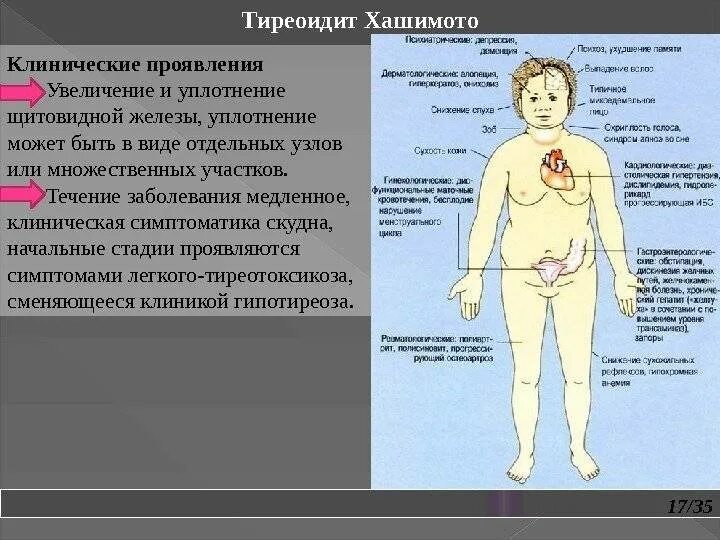 Диффузный аутоиммунном тиреоидите. Болезнь Хашимото гипотиреоз. Аутоиммунные заболевания щитовидной железы. Аутоиммунный тиреоидит щитовидной. Болезнь Хашимото (аутоиммунный тиреоидит).