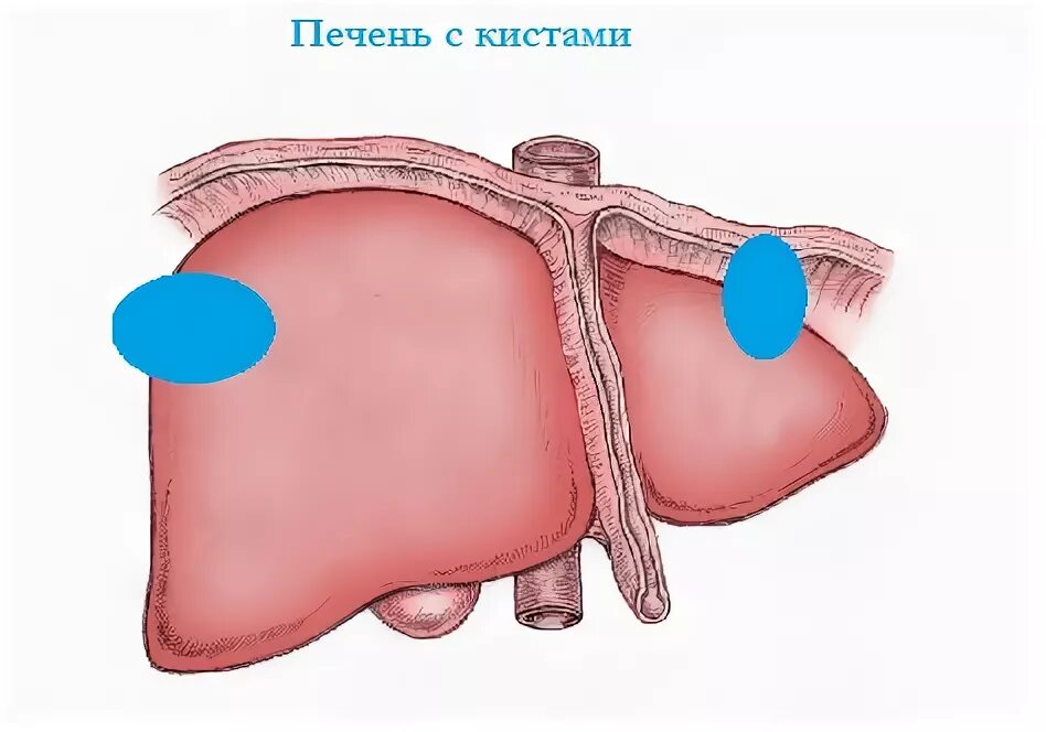Как лечить кисту печенью