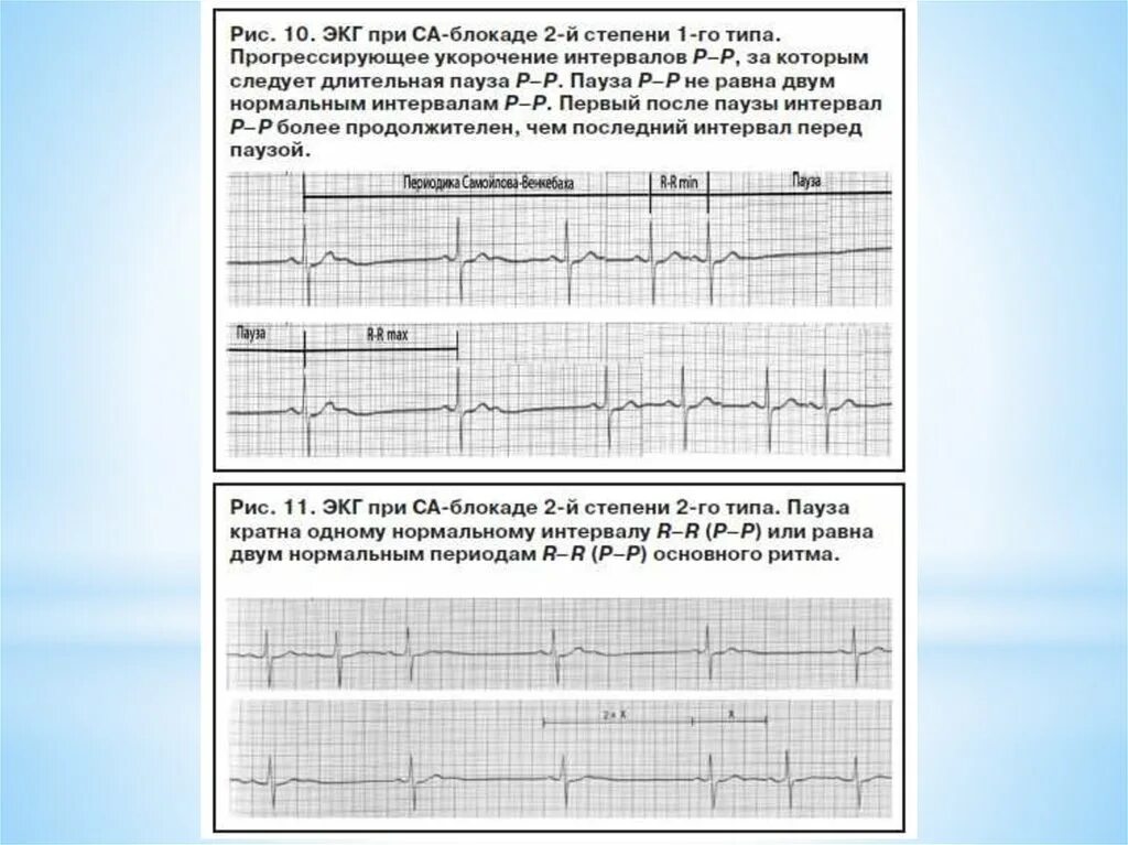 Са блокада типы. Синоатриальная блокада 2 степени на ЭКГ. Синоаурикулярная блокада 1 степени на ЭКГ. Са блокада 2 степени 2. ЭКГ при синоатриальной блокаде 3 степени.