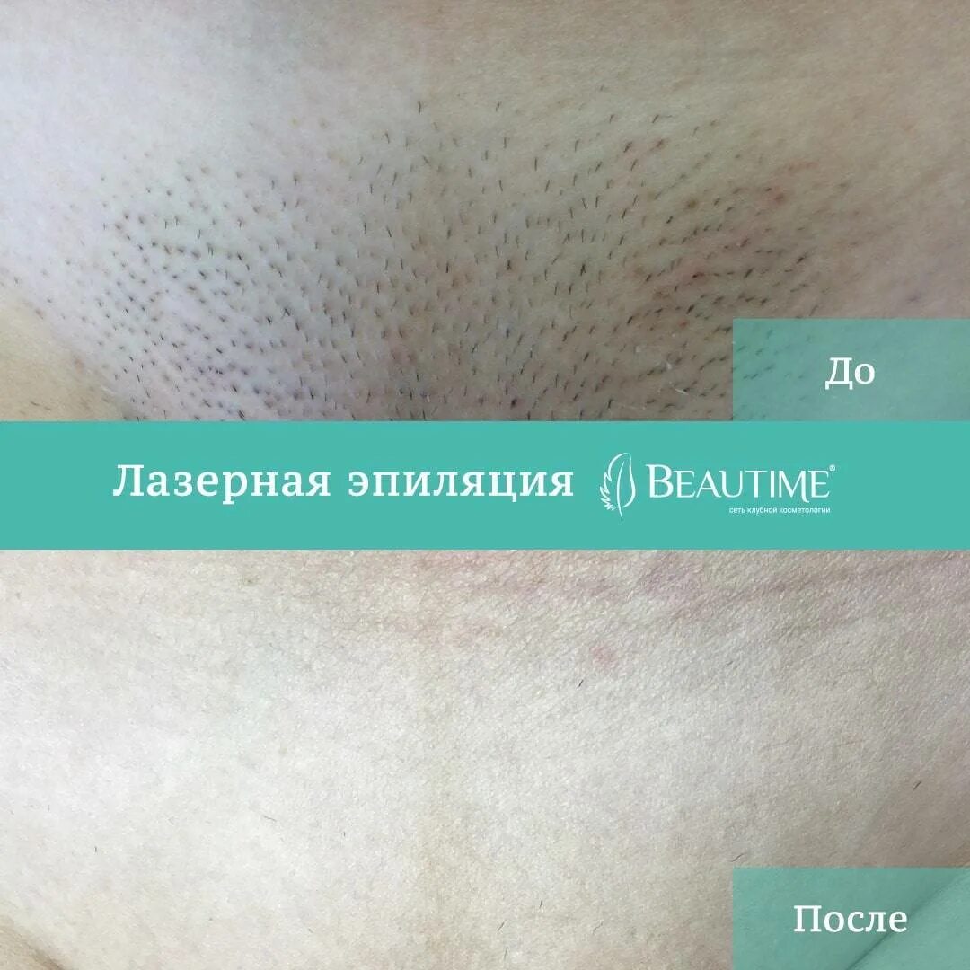 Чем отличается эпиляция от депиляции. Депиляция и эпиляция разница. отличие эпиляции от депиляции. эпиляция и депиляция в чем разница. шугаринг и депиляция в чем разница.