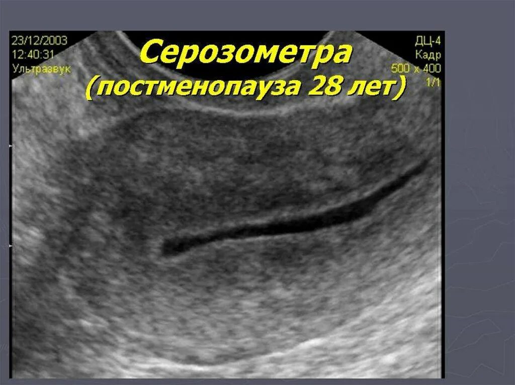 Ультразвуковая анатомия матки. Лечение серозометра матки после 60