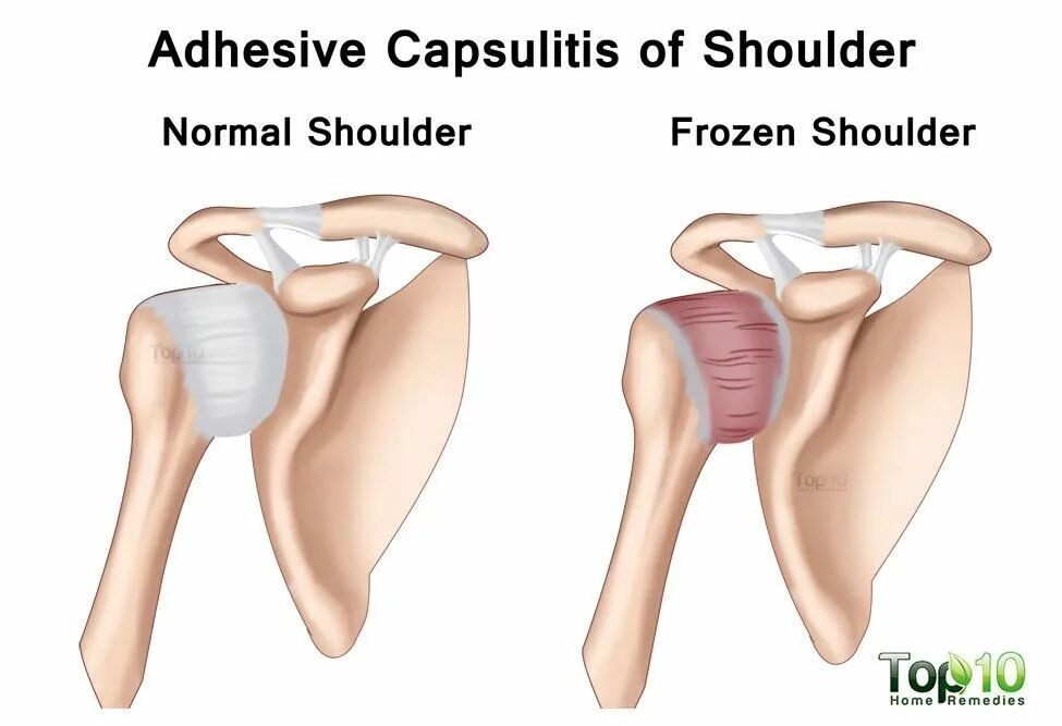 Как лечить капсулит. Плечелопаточный периартрит плечевого сустава. Адгезивный капсулит плеча рентген. Адгезивный капсулит плечевого сустава. Воспаление в плечевом суставе капсулит.