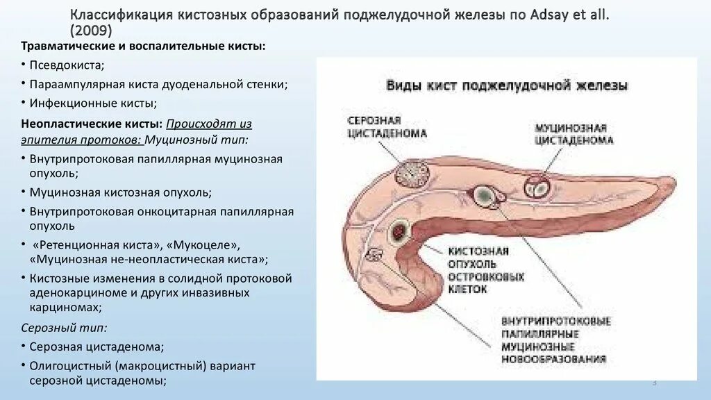 Истинные кисты поджелудочной железы классификация. Кистозные образования поджелудочной железы. Кистозные образования поджелудочной железы классификация. Кисты поджелудочной железы кт классификация. Фиброзные изменения поджелудочной железы