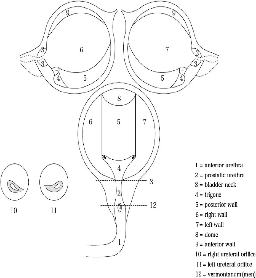 Киста яичника orads. Vi rads мочевой пузырь критерии. Vi-rads 1. Vi-rads классификация.