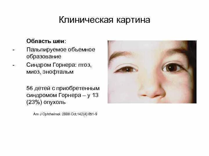 Синдром горнера это. Синдром горнера это