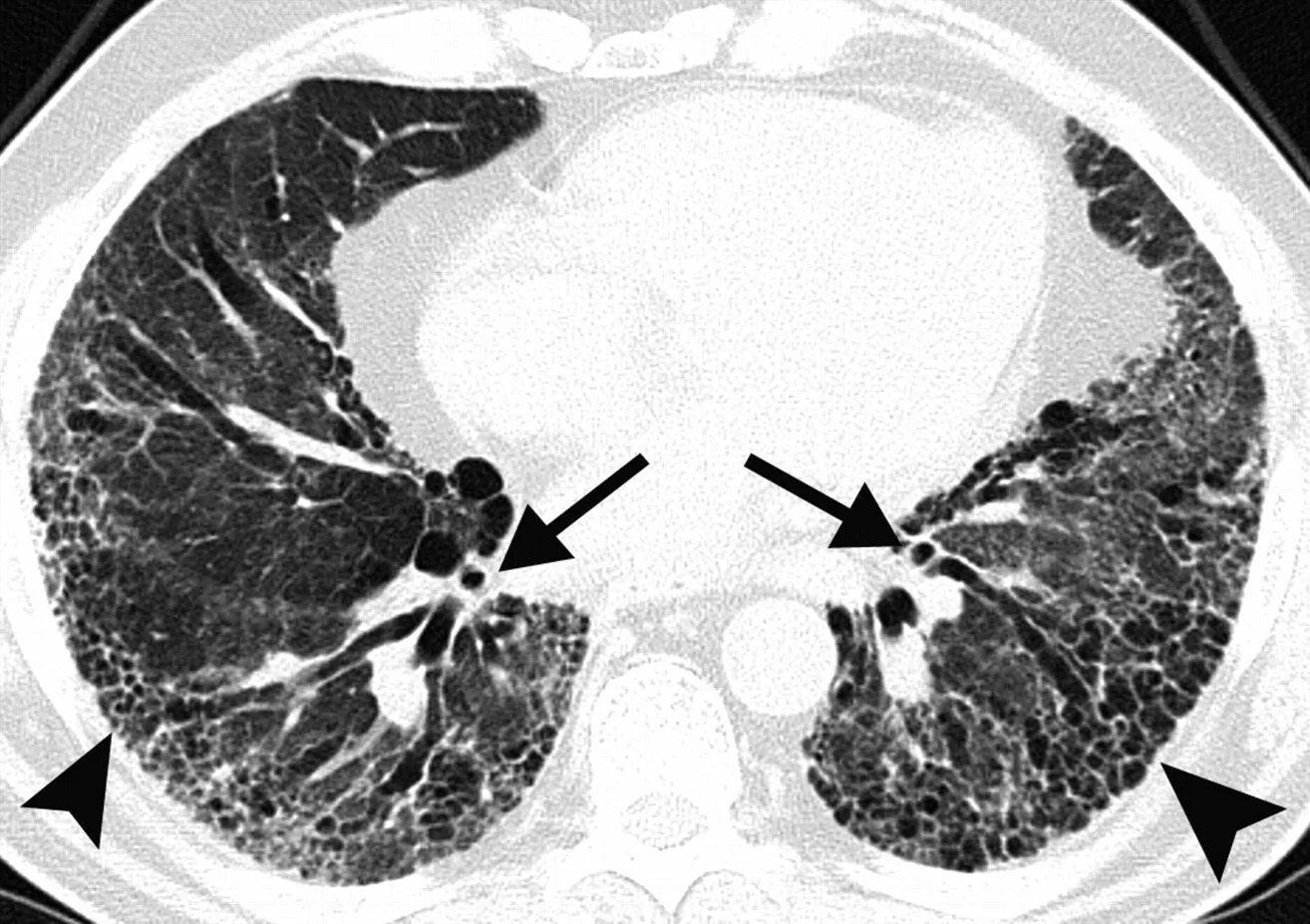 Фиброз ковид. Системная склеродермия поражение легких кт. Идиопатический легочный фиброз кт. Интерстициальный фиброз легких кт. Интерстициальный легочный фиброз кт.