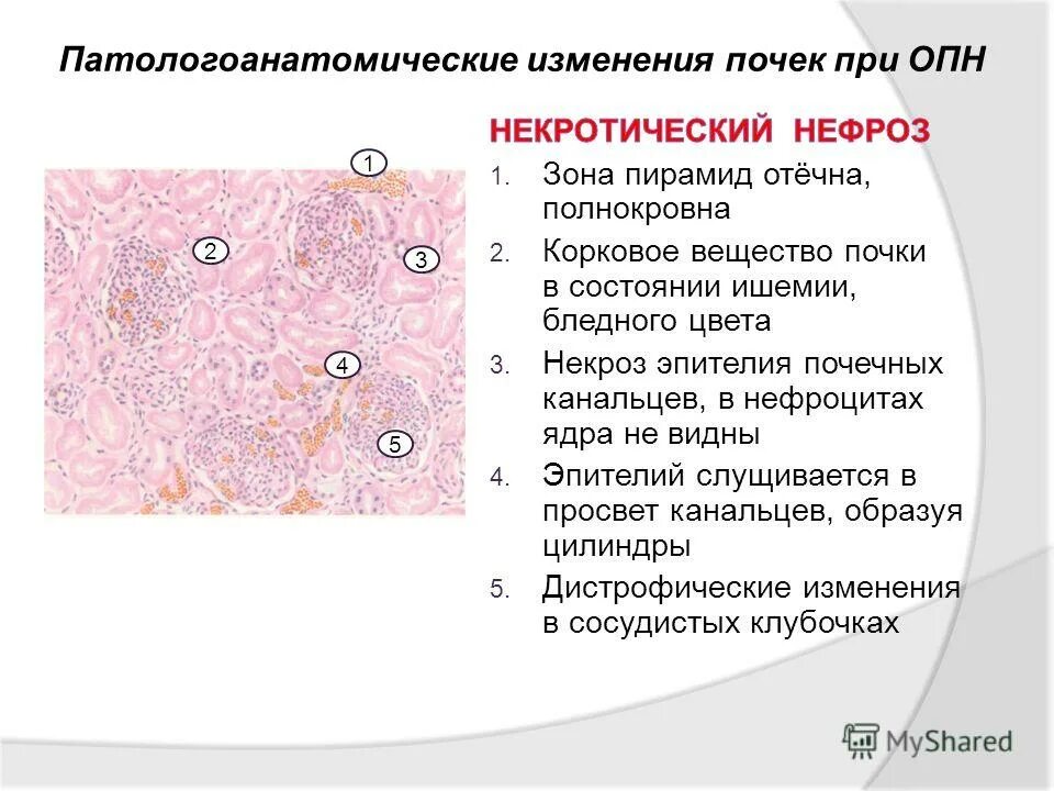 Признаки микро. Некротичсекий нефрозпатанатомия. Некроз эпителия извитых канальцев почки патогенез. Почка при ОПН макропрепарат. Некротический нефроз патанатомия.