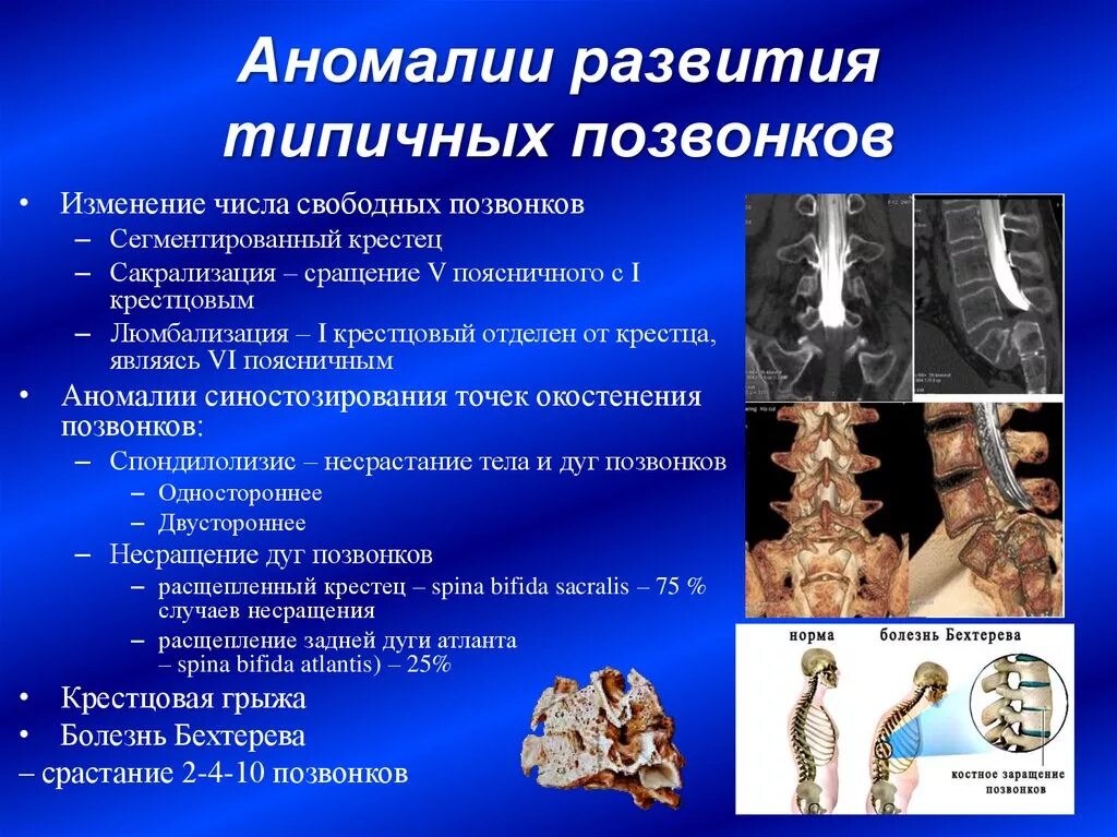 Аномалии развития нерва. Дефекты позвонков врожденные. Аномалии развития позв. Аномалии развития позвонков. Аномалия развития позвонка.