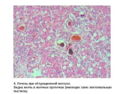 Печень при застойной желтухе микропрепарат