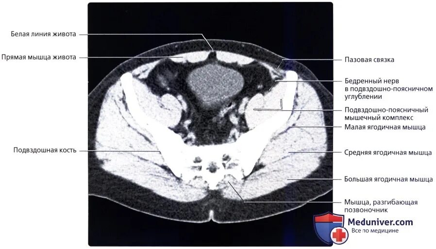 Кт подвздошной кости. Подвздошная кость анатомия кт. Строение подвздошной кости кт. Анатомия подвздошной кости кт. Кт анатомия таза.