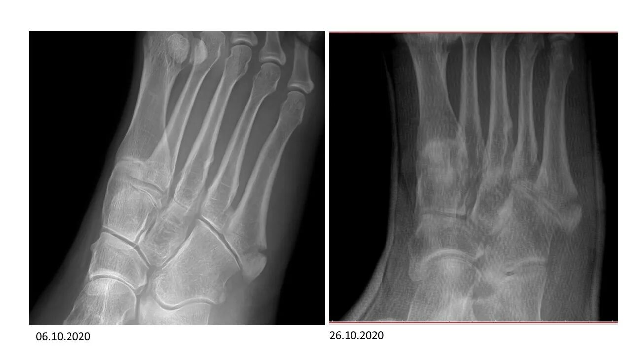 Трещина 5. Перелом 5 плюсневой кости Кост. Рентген перелома 5 плюсневой кости. Перелом Джонса 5 плюсневой кости стопы. Перелом бугристости 5 плюсневой.