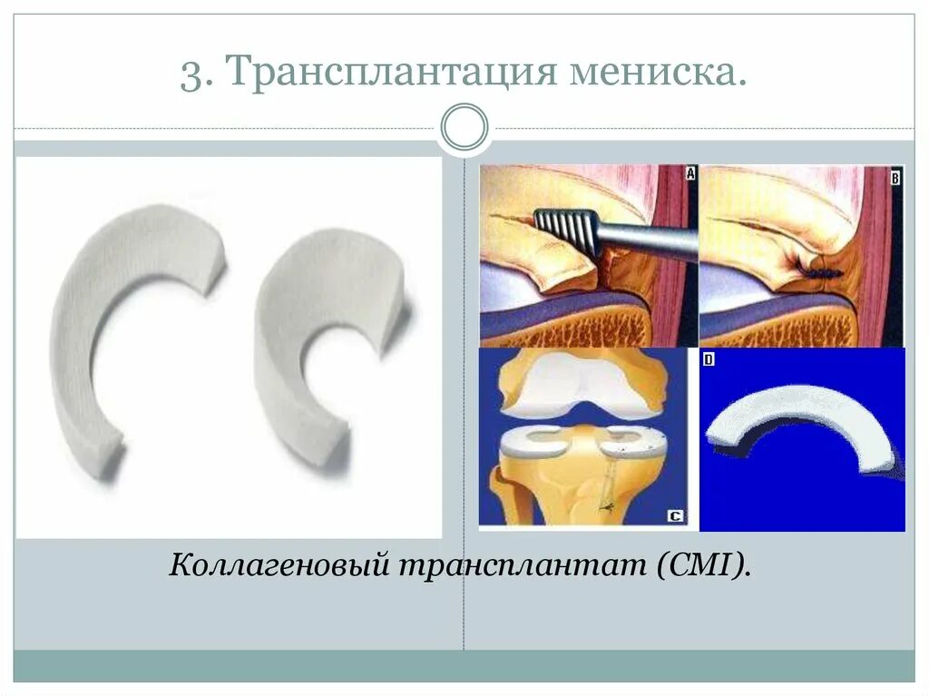 Типы разрывов мениска. Трансплантация мениска.