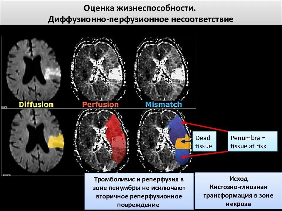 Кистозно атрофические изменения головного. Кт перфузия головного мозга. Кистозно-глиозная трансформация. Кт перфузия головного мозга при ишемическом. Глиозные изменения головного мозга на кт.