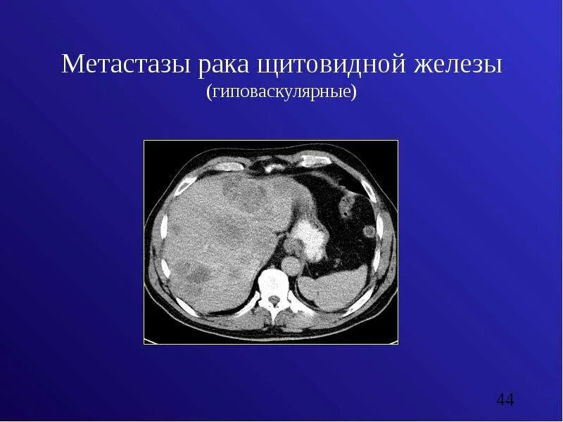 Гиповаскулярные метастазы печени кт. Метастазирование щитовидной железы. Метастазы опухоли щитовидной железы.