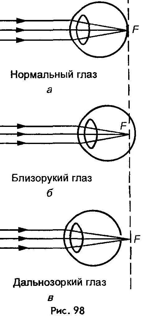 Нормальный глаз схема. Схемы рефракции при нормальном зрении. Схемы хода лучей в глазе при близорукости и дальнозоркости. Схема рефракции в близоруком глазу. Дальнозоркость близорукость оптическая схема.