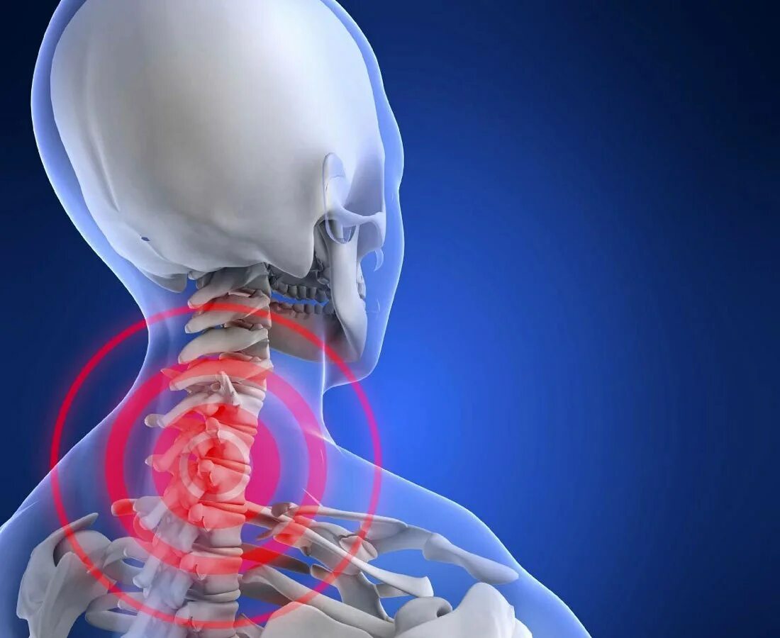 Хондроз шейного отдела позвоночника симптомы. Шейный спондилез. Шейный остеохондроз. Itqysqотдел позвоночника.