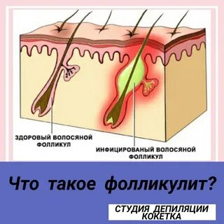 Устье волосяного фолликула