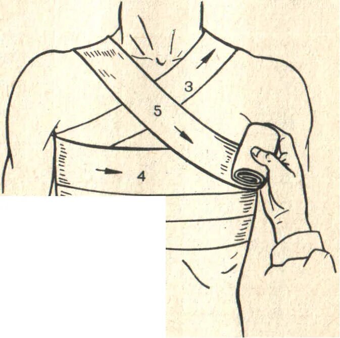 Повязка на грудную клетку алгоритм. Спиралевидная повязка на грудную клетку. Крестообразная повязка на грудную клетку алгоритм. Спиралевидная повязка на грудную клетку показания. Десмургия спиральная повязка на грудь.