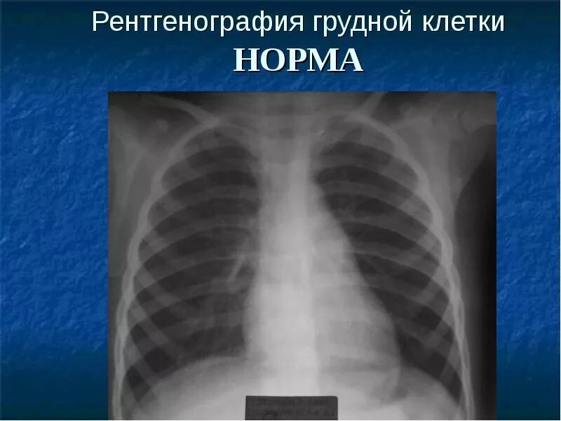 Рентгенография грудной клетки норма. Рентген органов грудной клетки норма и патология. Рентгенограмма грудной клетки норма. Рентген грудной клетки ребенка норма. Какие легкие в норме