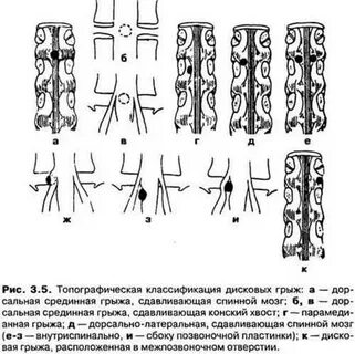 Размеры поясничных грыж