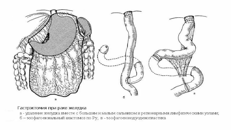 Схема субтотальной резекции желудка. Гастрэктомия желудка ход операции. Проксимальная субтотальная резекция желудка схема. Тотальная гастрэктомия схема.