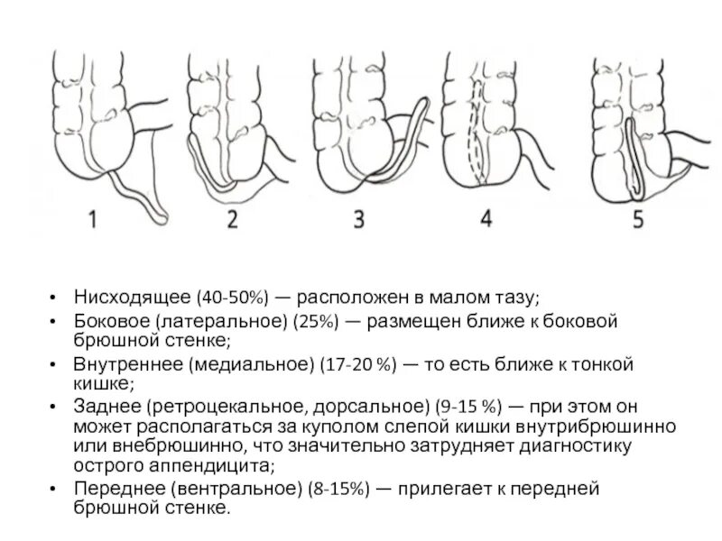 Варианты аппендицита. Ретроцекальный аппендицит расположение. Варианты положения червеобразного отростка. Ретроцервикальное расположение аппендикса. Ретроцекальное положение аппендикса.