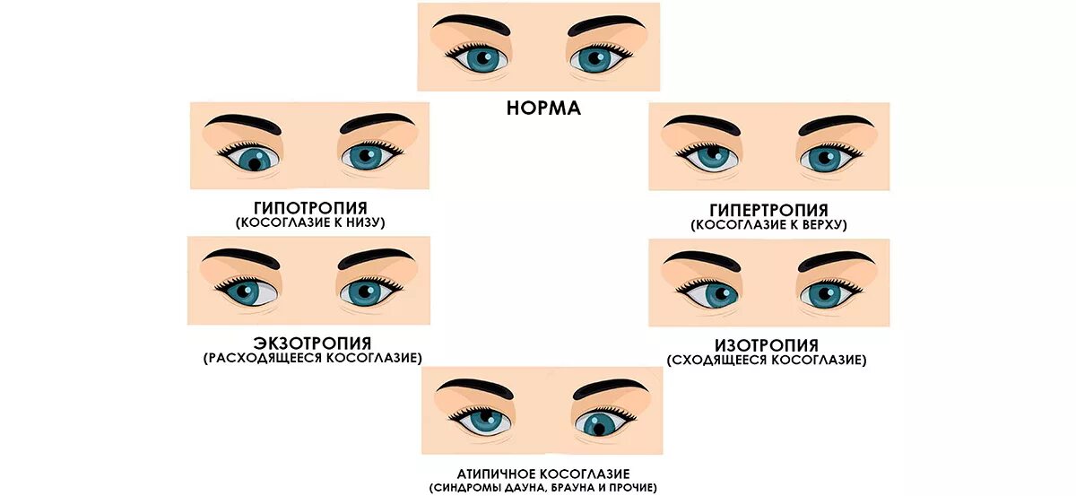 Немного косят глаза. Монолатеральное сходящееся косоглазие. Косоглазие степень зрения. Косоглазие у детей эзотропия. Схема сходящиеся косоглазие.