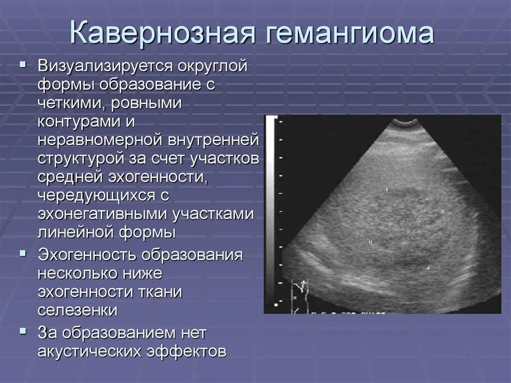 Что значит печень неоднородная. Кавернозная гемангиома печени на УЗИ. Гистогенез гемангиомы печени. Кавернозная гемангиома селезенки УЗИ. Гемангиома селезенки на УЗИ.