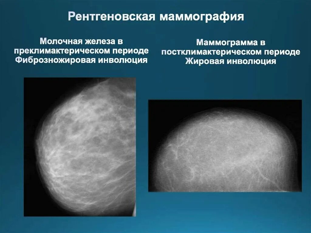 Фиброзно-жировая инволюция молочных желез рентген. Жировая инволюция молочных желез маммография. Жировая инволюция молочных желез что это такое. Инволютивные изменения молочных желез. Признаки фиброзных изменений молочных желез