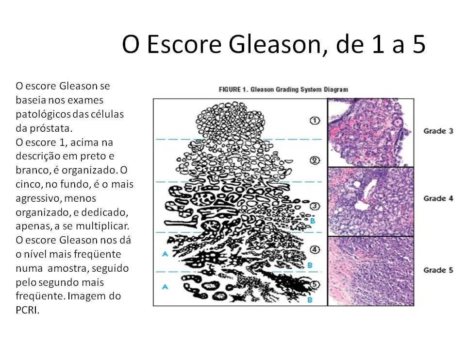 Глисон простата. Глисон 7 3+4. Классификация Глисона. Оценка по глисону. Gleason классификация.