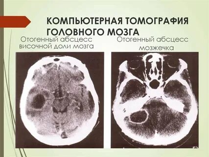 Абсцесс головного мозга
