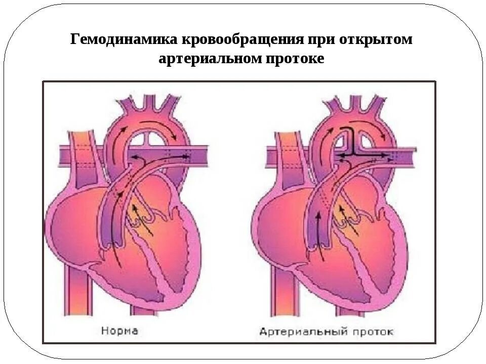 Открытый артериальный (боталлов) проток. Открытый артериальный проток нарушение гемодинамики. Открытый артериальный боталлов проток гемодинамика. Артериальный боталлов проток соединяет. Гемодинамика у детей