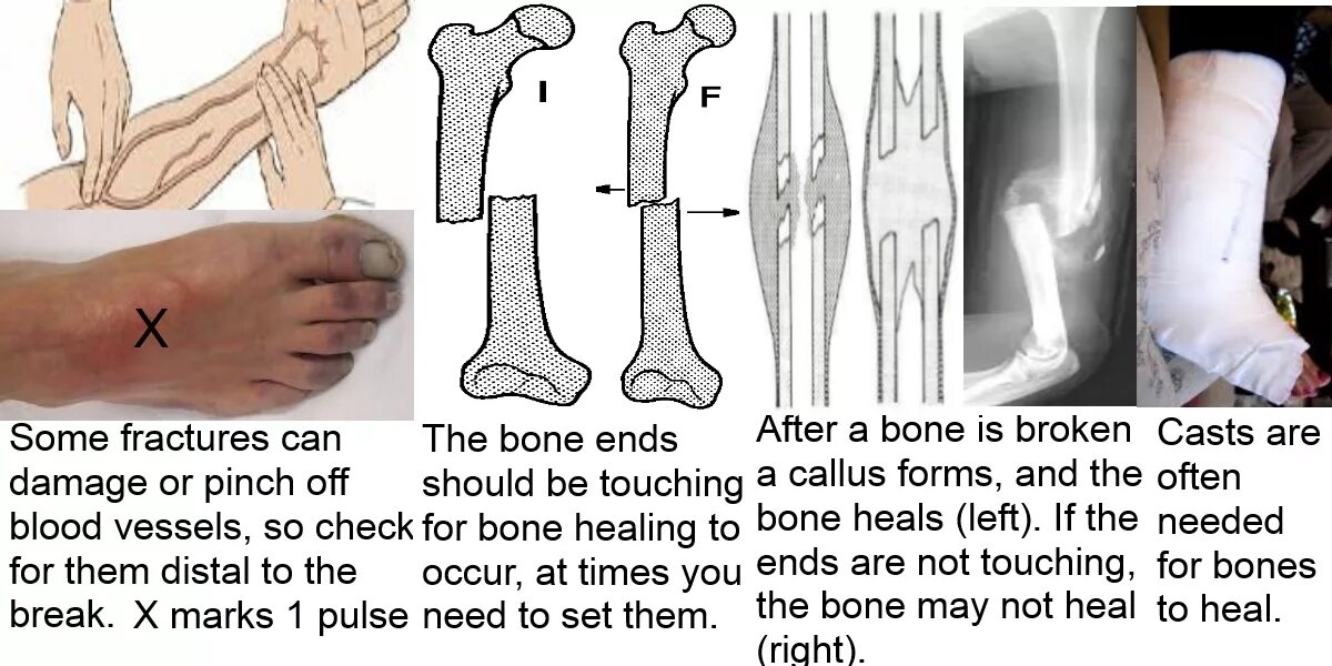 Break a bone. Страшные переломы костей. Трещина кости биология.