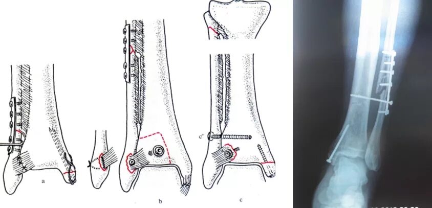 Остеосинтез малой берцовой Кост. Перелом лодыжки с остеосинтезом. Внутрикостный остеосинтез лодыжки. Перелом малоберцовой кости остеосинтез. Операция малоберцовой кости