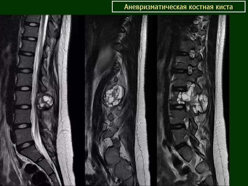 Киста в пояснице. Периневральная киста l1-l2. Периневральная киста с7-тн1. Периневральная киста l5-s1. Периневральная киста позвоночника поясничного отдела s3.