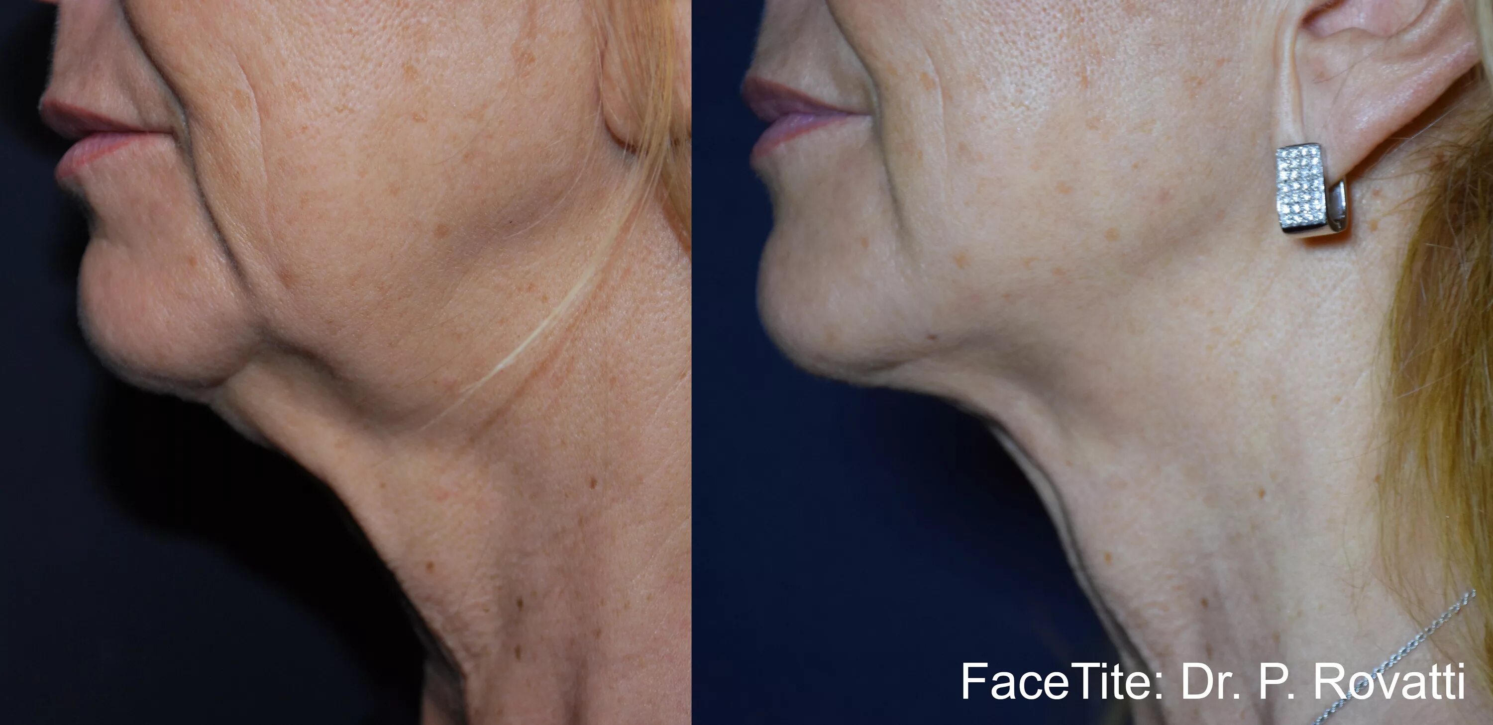 Микроигольчатый морфеус 8. Морфеус 8. лифтинг face tite.