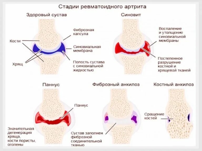 Маркеры артрита. Pannus ревматоидный артрит. Характерные изменения суставов при ревматоидном артрите. Ревматоидный артрит суставной симптомы. Ревматоидный артрит суставные проявления.