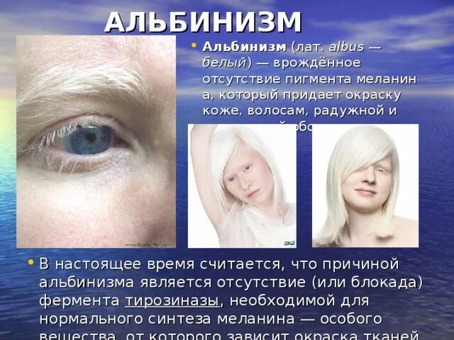 Клинические симптомы альбинизма. Альбинизм наследственное заболевание. Альбинизм клинические проявления. Альбинизмом страдают