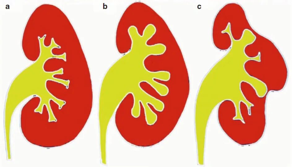 Расширенная члс. Каликопиелоэктазия почек что это такое. Расширение чашечно-лоханочной системы. Расширение чашечно-лоханочной системы почек на кт.