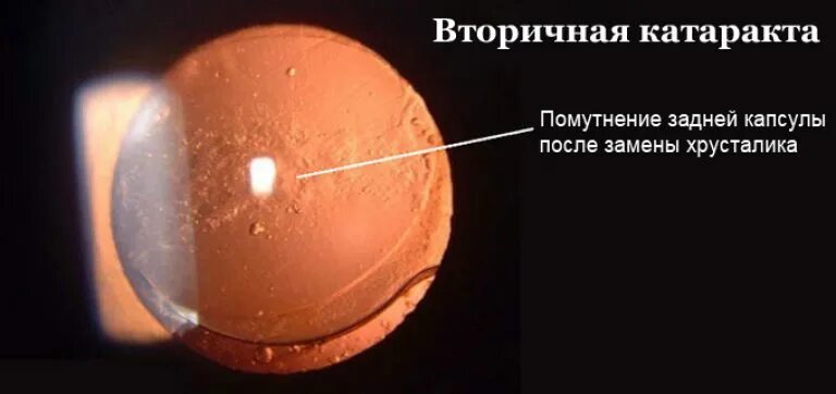 Через какое время восстанавливается хрусталик. Иаг лазерная дисцизия вторичной катаракты. вторичная катаракта шары адамюка-эльшнига. лазерная дисцизия задней капсулы хрусталика. вторичная катаракта помутнение задней капсулы.