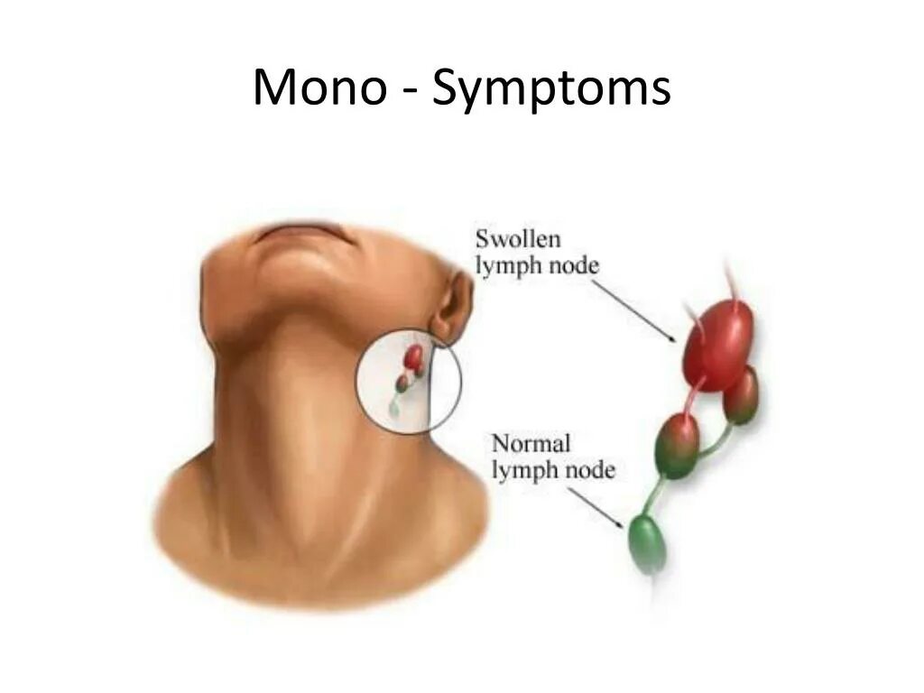 Как правильно лимфоузел. Лимфаденит воспаление лимфатических узлов. Воспаления лимфа лимфоузлы. Лимфатические узлы на шее увеличены.
