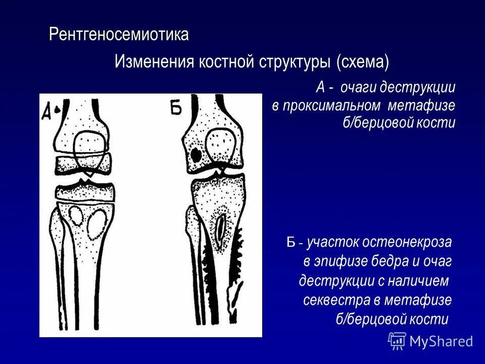 Структурные изменения костей. Эностозы большеберцовой кости. Дистальный метаэпифиз большеберцовой кости. Проксимальный метаэпифиз бедренной кости. Деструкция бедренной кости.