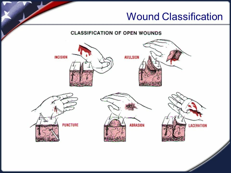 What is a wound. What is a wound