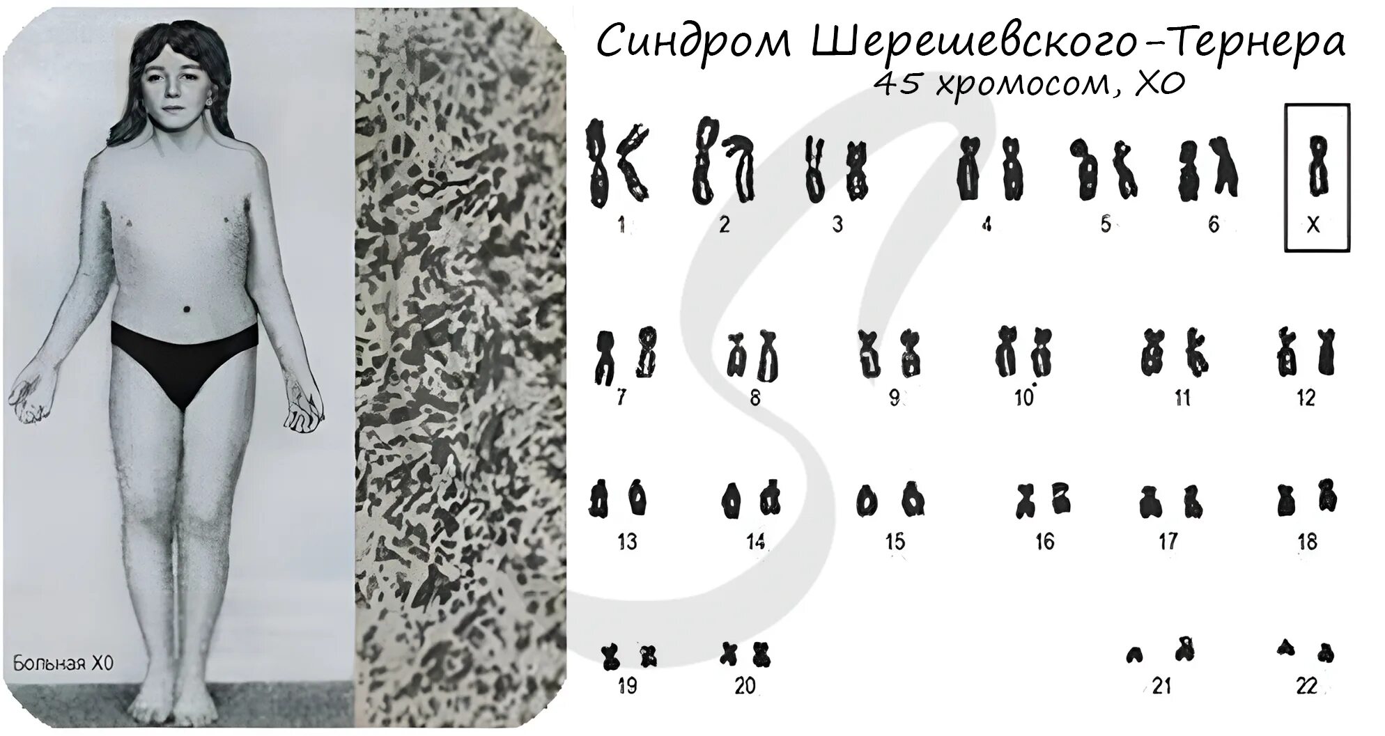 Трипло х. Синдром Тернера (моносомия х хромосомы). Шерешевского Тернера мозаичная форма синдрома Шерешевского-Тернера. Геномные мутации Шерешевского Тернера. Дисгенезия гонад (синдром Шерешевского-Тернера).