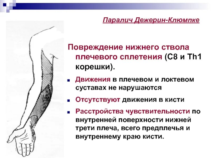 Невропатия локтевого мкб. Нижний дистальный Тип акушерского пареза (Дежерин-Клюмпке). Паралич Дежерин Клюмпке клиника. Синдром поражения плечевого сплетения неврология. Симптом Дежерина Клюмпке.