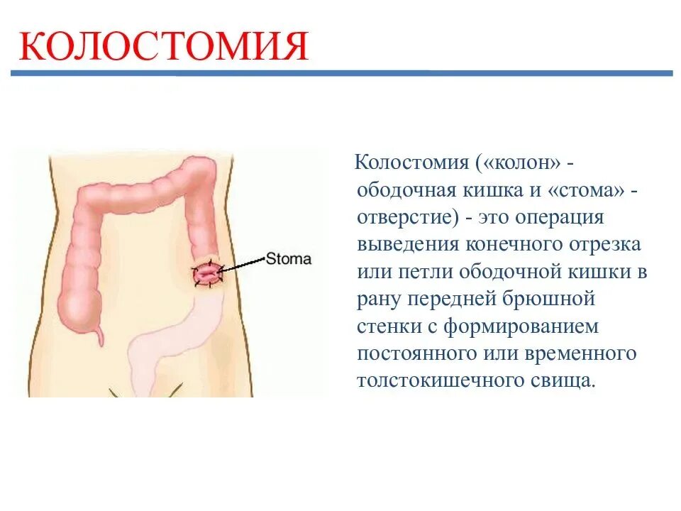 Илеостома стомы Толстого кишечника. Резекция прямой кишки с наложением стомы. Колостома после операции прямой кишки.